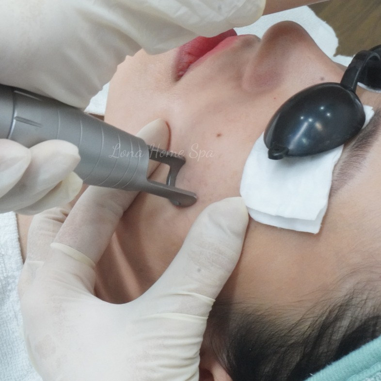Trong bối cảnh điều trị da, hình ảnh minh họa cho trị sạm da tại Cần Thơ cho thấy cách mà trị sạm da Cần Thơ được thực hiện bởi chuyên gia Lona qua quy trình điều trị nám da Cần Thơ tại spa uy tín Cần Thơ, kết hợp chăm sóc da chuyên sâu an toàn.