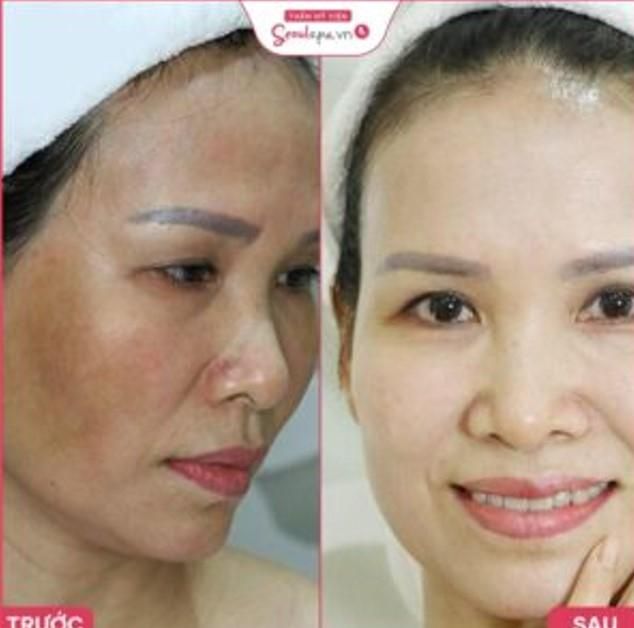 SeoulSpa Bến Tre - thẩm mỹ viện trị nám Bến Tre