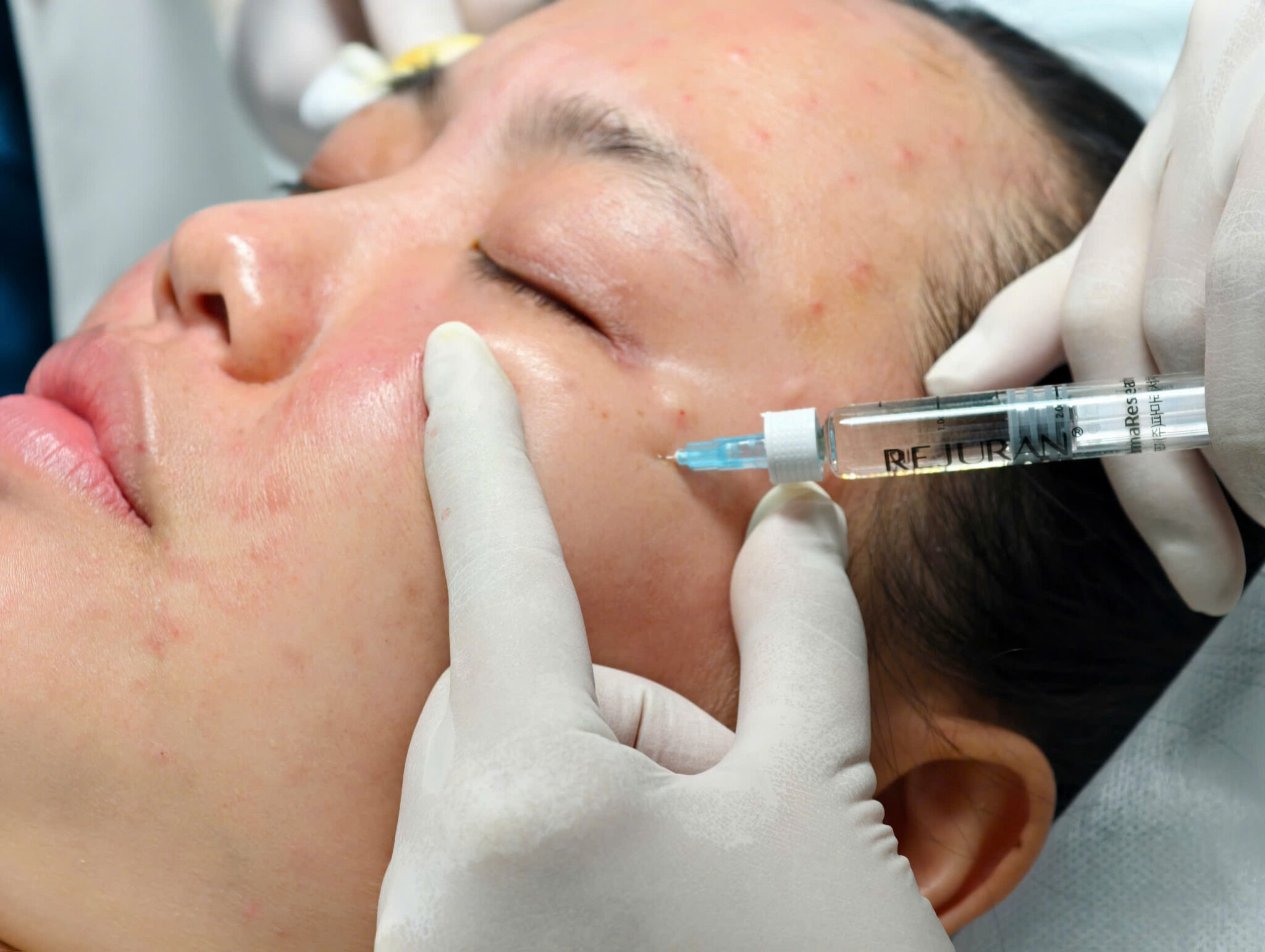 Với công nghệ hiện đại, tiêm bắp Cần Thơ tại Lona Skin Lab mang lại hiệu quả vượt trội, chứng tỏ năng lực của các bác sĩ giỏi Cần Thơ trong việc thực hiện dịch vụ thẩm mỹ Cần Thơ tại phòng khám da liễu Cần Thơ.