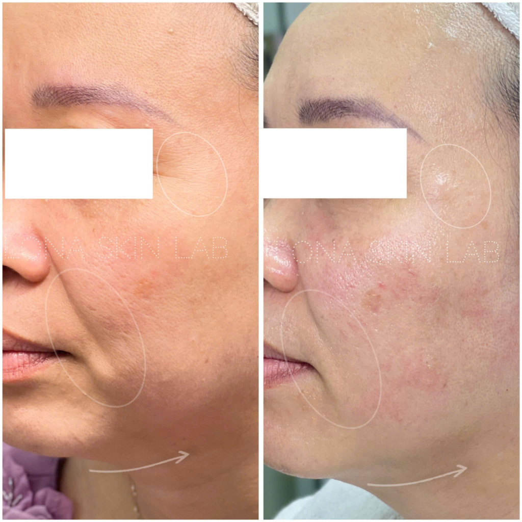 Quy trình tiêm bắp Cần Thơ chuyên nghiệp tại Lona Skin Lab được các bác sĩ giỏi Cần Thơ kiểm soát nghiêm ngặt, khẳng định chất lượng dịch vụ thẩm mỹ Cần Thơ và uy tín của phòng khám da liễu Cần Thơ.