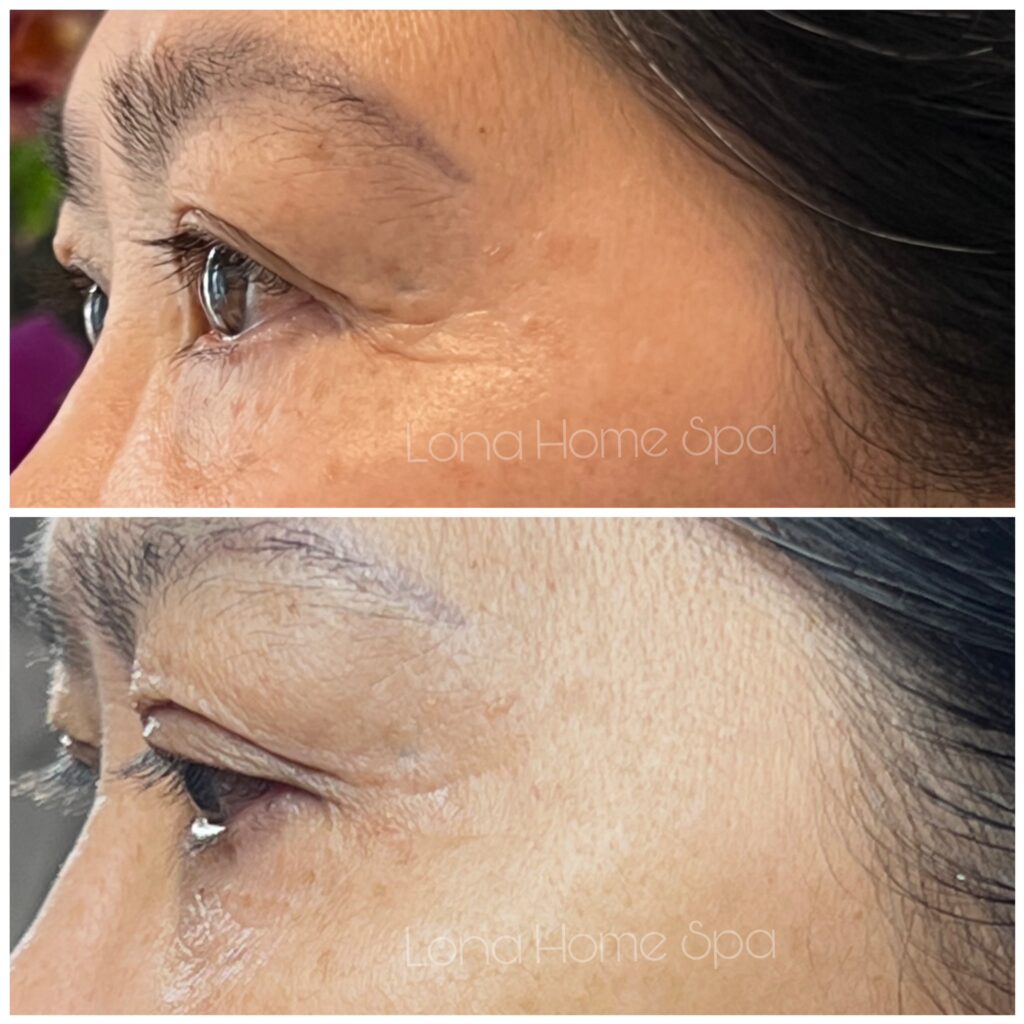 Quy trình trẻ hóa vùng mắt kết hợp xóa nhăn đuôi mắt Cần Thơ bằng tiêm Botox đuôi mắt do chuyên gia Lona hướng dẫn, mang lại dịch vụ thẩm mỹ Cần Thơ an toàn và hiệu quả.