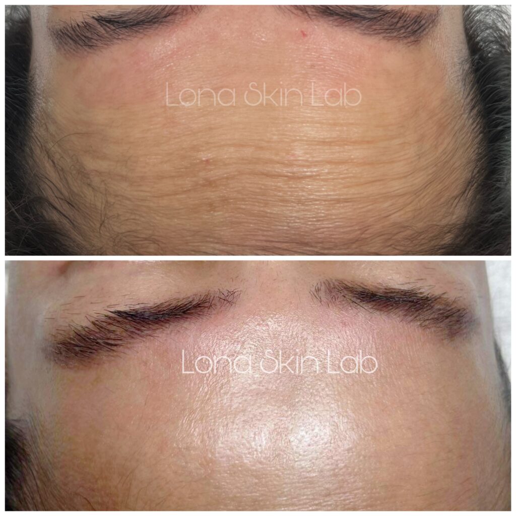 Bức ảnh trước và sau liệu trình tiêm botox tại Cần Thơ tại Lona Skin Lab thể hiện sự hiệu quả của dịch vụ tiêm botox Cần Thơ, chứng minh rằng bác sĩ giỏi tiêm botox Cần Thơ luôn chú trọng đến tiêm botox an toàn Cần Thơ.