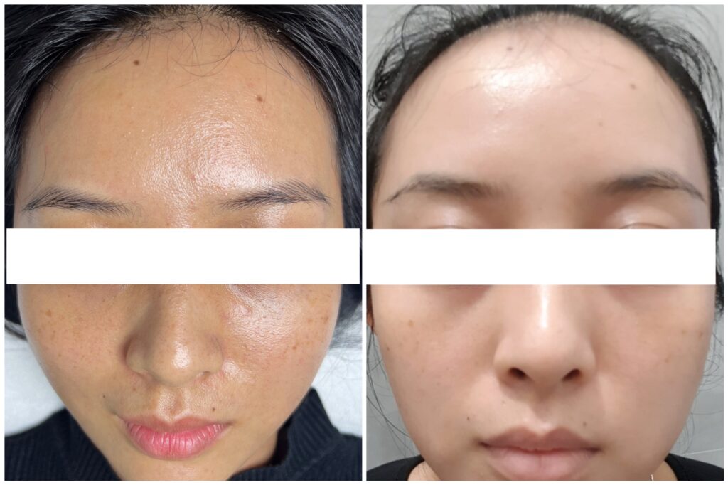 Liệu trình trẻ hóa da công nghệ cao tại Cần Thơ với Exosome do các bác sĩ giỏi trẻ hóa da của Lona Skin Lab chỉ định mang lại hiệu quả tức thì.