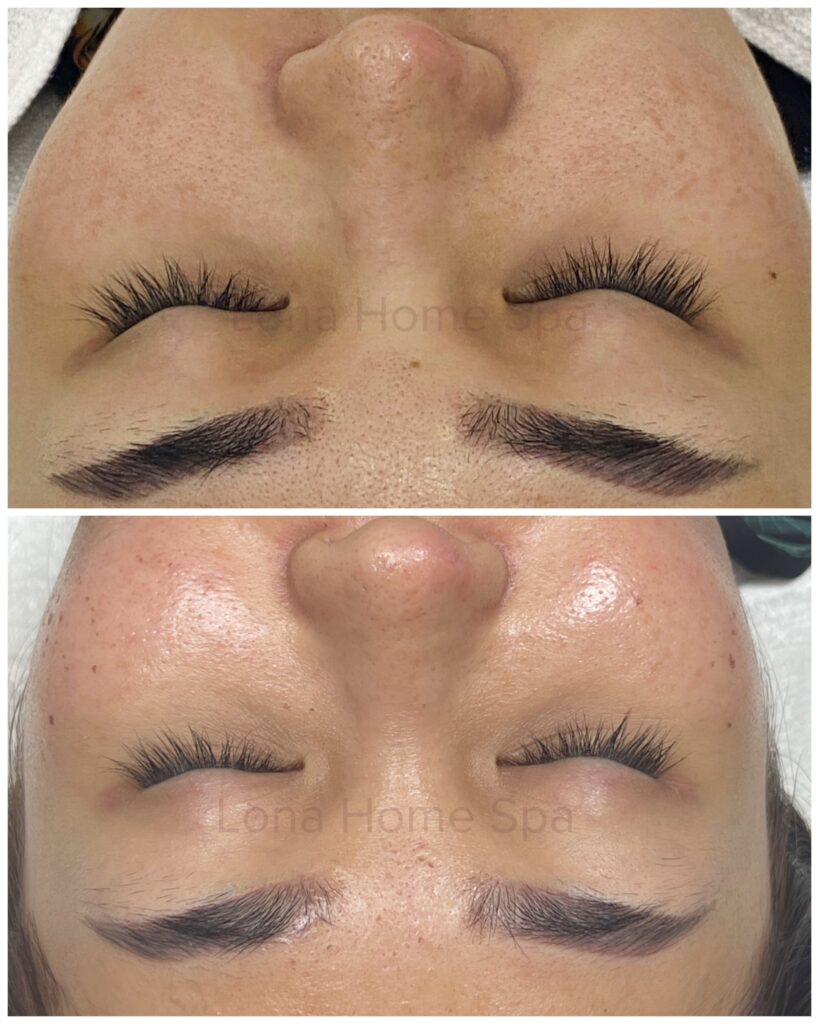 Laser Fractional kết hợp với công nghệ trị sẹo rỗ giúp cải thiện rõ rệt hiệu quả điều trị sẹo rỗ tại Cần Thơ.