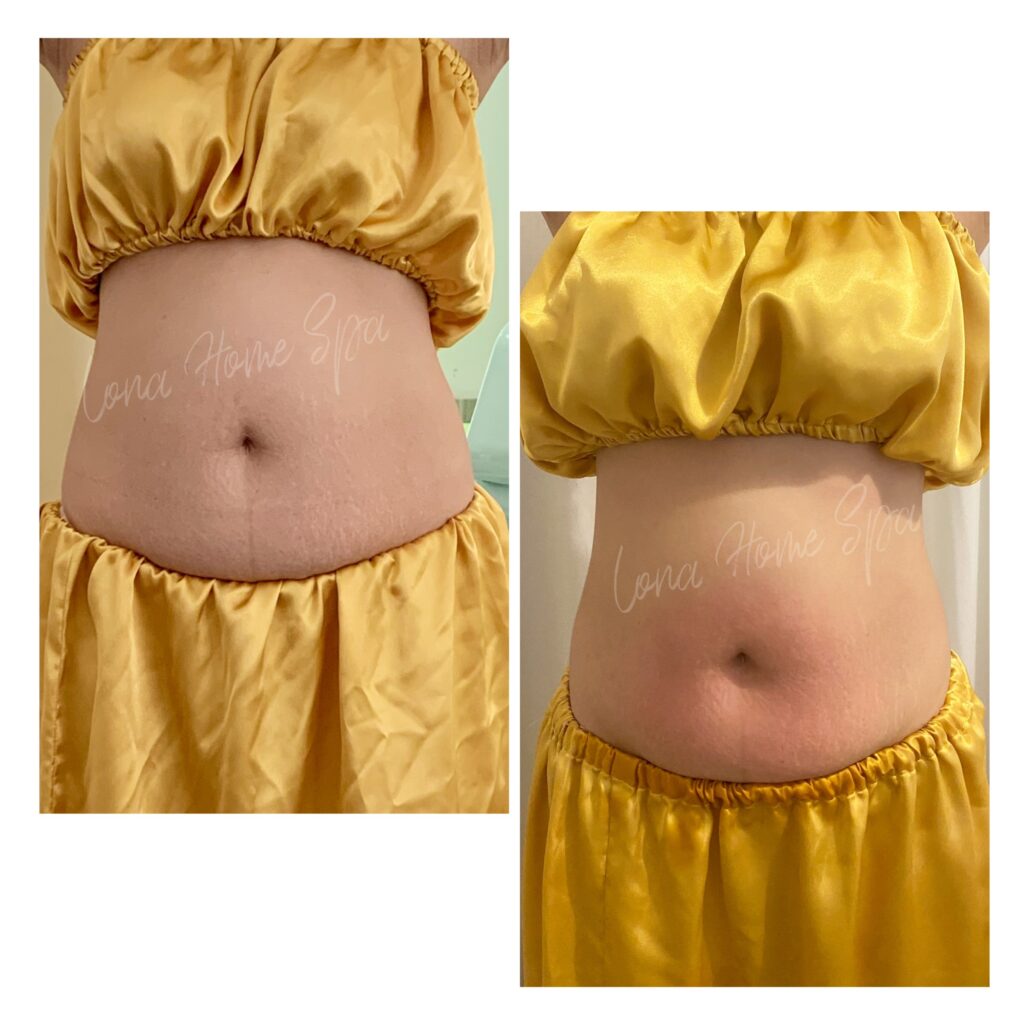 Hình ảnh trước và sau khi áp dụng phương pháp giảm mỡ má tại Cần Thơ của chuyên gia Lona, thể hiện giảm mỡ má, giảm mỡ mặt và giảm béo mặt an toàn và tự nhiên.