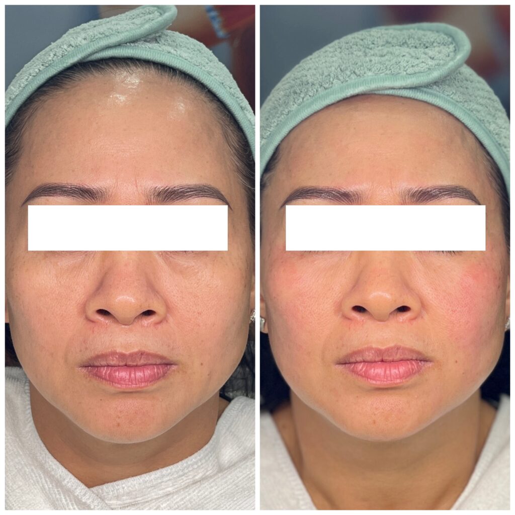 Trong bức ảnh này, HIFU nâng cơ tại Cần Thơ được thể hiện qua Hifu nâng cơ Cần Thơ với sự dẫn dắt của những bác sĩ giỏi nâng cơ tại Lona Skin Lab, đem lại hiệu quả trẻ hóa da Cần Thơ nhờ vào công nghệ Hifu hiện đại.