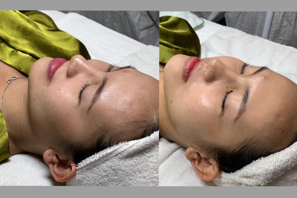 Khuôn mặt sau khi bắn laser được thể hiện rõ ràng trong hình ảnh này, đồng thời chăm sóc da sau laser được áp dụng theo lời khuyên từ Lona Skin Lab nhằm phục hồi da sau laser và thực hiện chăm sóc da sau điều trị laser chuyên sâu.