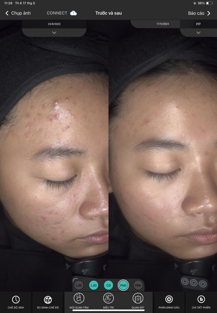 Kết quả điều trị mụn viêm tại Cần Thơ được thể hiện qua ảnh before-after cho thấy hiệu quả của phương pháp trị mụn; dưới sự giám sát của chuyên gia, liệu trình điều trị mụn viêm giúp duy trì chăm sóc da mụn vượt trội.