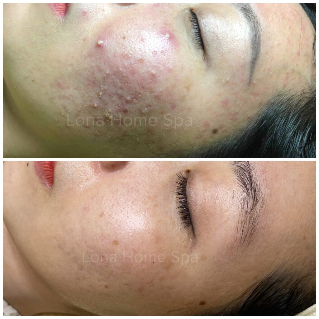 Tảo xoắn trị mụn tại Cần Thơ được chuyên gia Lona sử dụng trong liệu trình trị mụn bằng tảo xoắn tại spa trị mụn Cần Thơ mang lại hiệu quả cao.
