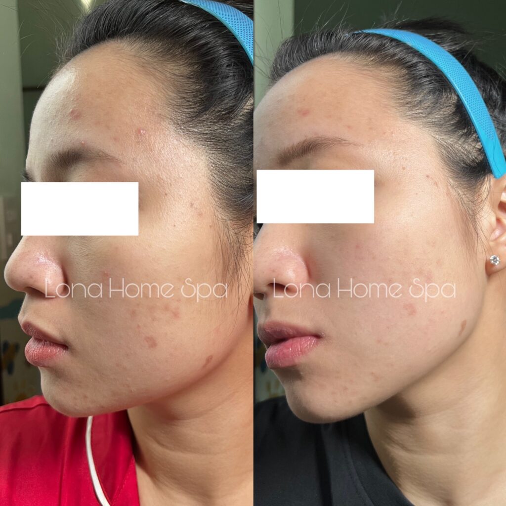 Trong hình before_after_mụn_21.jpg, hiệu quả của phương pháp phục hồi da sau mụn tại Cần Thơ được minh chứng với dịch vụ chăm sóc da sau mụn tại Lona Home Spa Cần Thơ, dưới sự chỉ dẫn của chuyên gia da liễu Cần Thơ nhằm đạt được trị mụn hiệu quả.