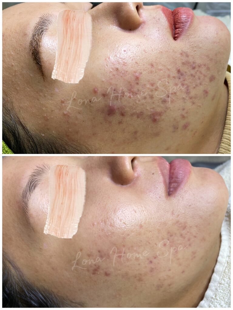 Phương pháp trị mụn hiệu quả tại Cần Thơ đã được áp dụng thành công khi chuyên gia chỉ đạo liệu trình điều trị mụn viêm, qua đó mang lại hiệu quả chăm sóc da mụn rõ rệt và cải thiện sức khỏe làn da.