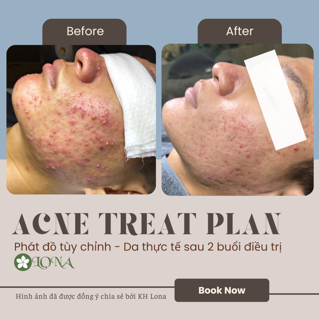 Hình ảnh minh chứng cho phác đồ điều trị mụn ở spa và phác đồ điều trị mụn được Lona Home Spa áp dụng, khẳng định vai trò của liệu trình trị mụn trong điều trị mụn hiệu quả tại spa trị mụn Cần Thơ.