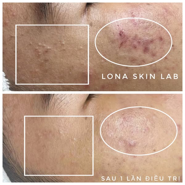 Ảnh chụp một ca thực tế của Lona Home Spa, thể hiện phác đồ điều trị mụn ở spa cùng liệu trình trị mụn chuyên sâu, góp phần mang lại điều trị mụn hiệu quả tại spa trị mụn Cần Thơ và củng cố phác đồ điều trị mụn.