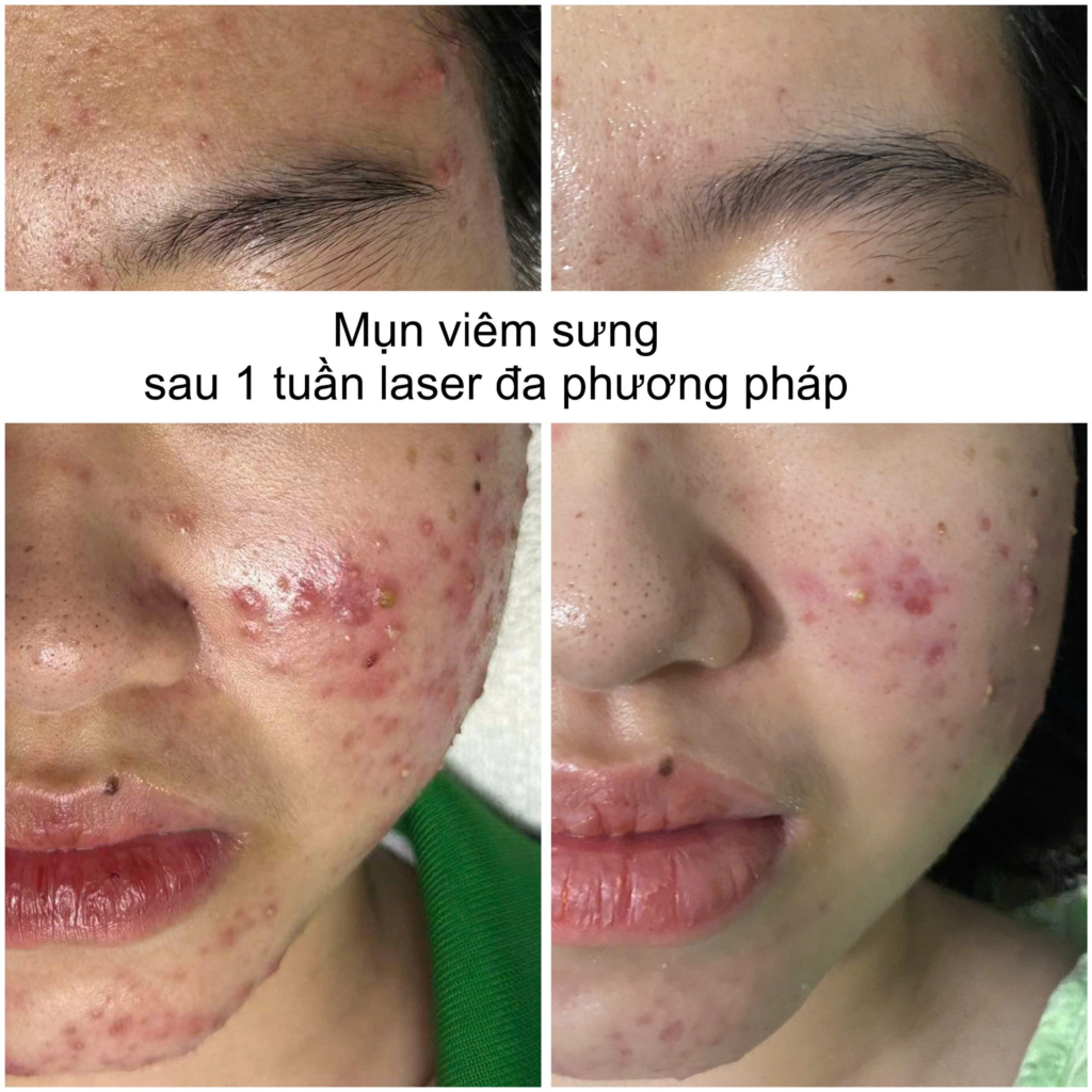 Hình ảnh khẳng định hiệu quả của tảo xoắn trị mụn tại Cần Thơ khi chuyên gia Lona khuyến nghị liệu pháp trị mụn bằng tảo xoắn tại spa trị mụn Cần Thơ.
