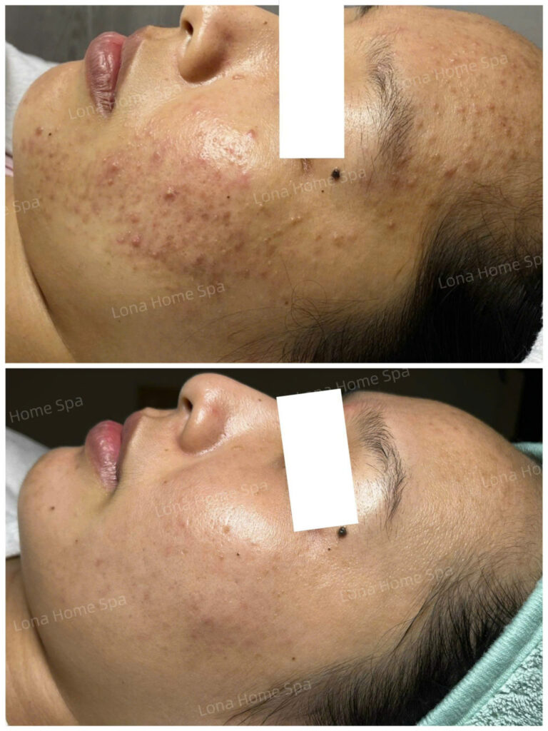 Ảnh minh họa quy trình trị mụn Cần Thơ tại phòng khám da liễu Cần Thơ, nhận được đánh giá bác sĩ da liễu Cần Thơ từ khách hàng.