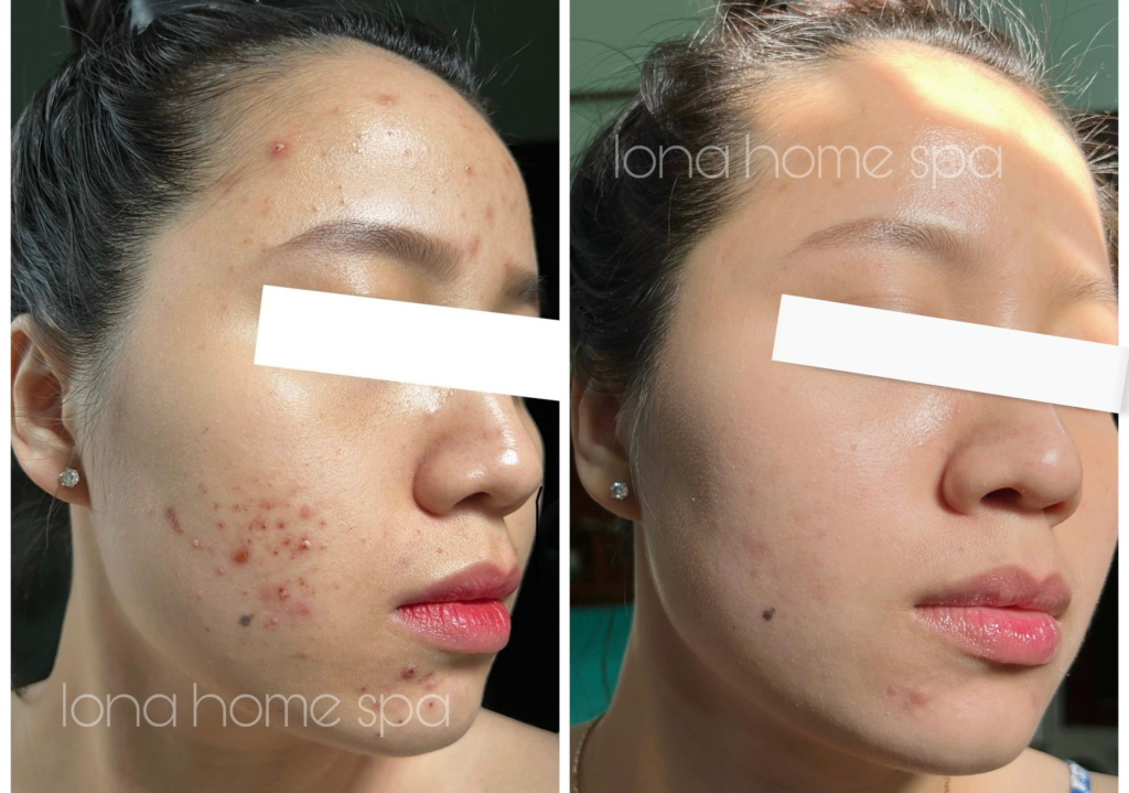 Tảo xoắn trị mụn tại Cần Thơ khi chuyên gia Lona phát triển liệu pháp trị mụn bằng tảo xoắn tại spa trị mụn Cần Thơ cho làn da khỏe.