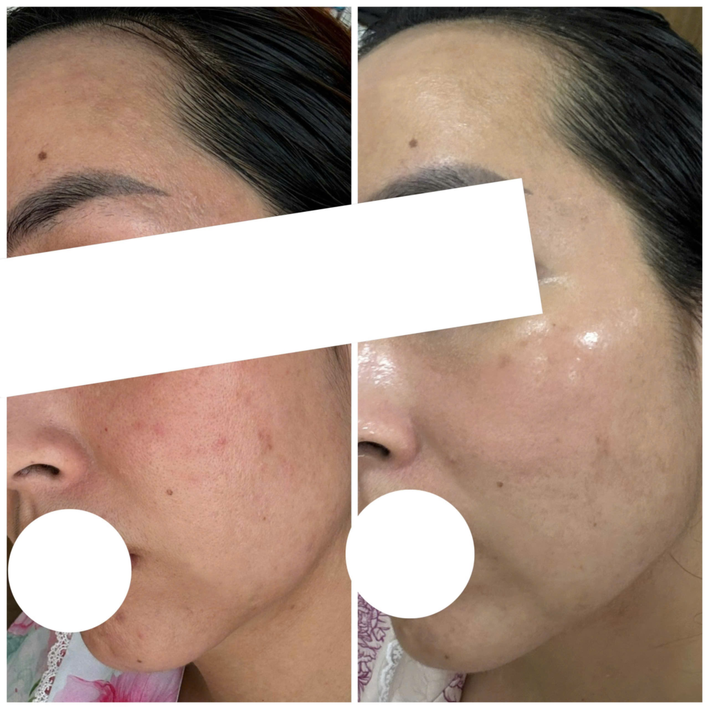 Hình ảnh được trình bày cùng với tác hại của việc trị nám bằng laser và tác hại trị nám bằng laser, mở đầu cho mục đích phân tích rủi ro biết rõ các biểu hiện phụ.