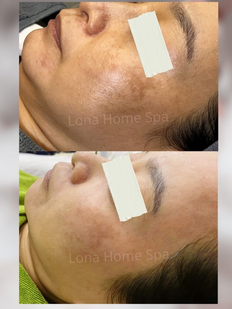 Qua hình ảnh, ta có thể đặt câu hỏi 'trị nám bằng laser có hại không' khi các biến chứng trị nám laser được ghi nhận trong quá trình điều trị và đánh giá cẩn trọng các khía cạnh liên quan.