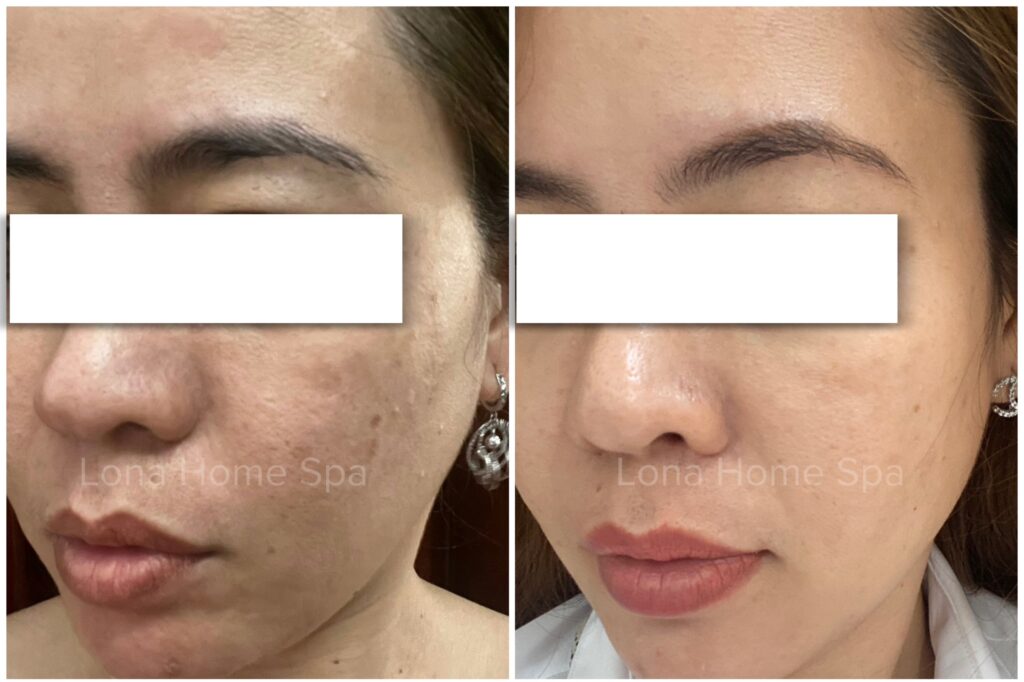 Hình ảnh này cho thấy rõ ràng tác hại của việc trị nám bằng laser và tác hại trị nám bằng laser, đồng thời mở rộng nhận diện rủi ro trị nám laser qua từng chi tiết biểu hiện.
