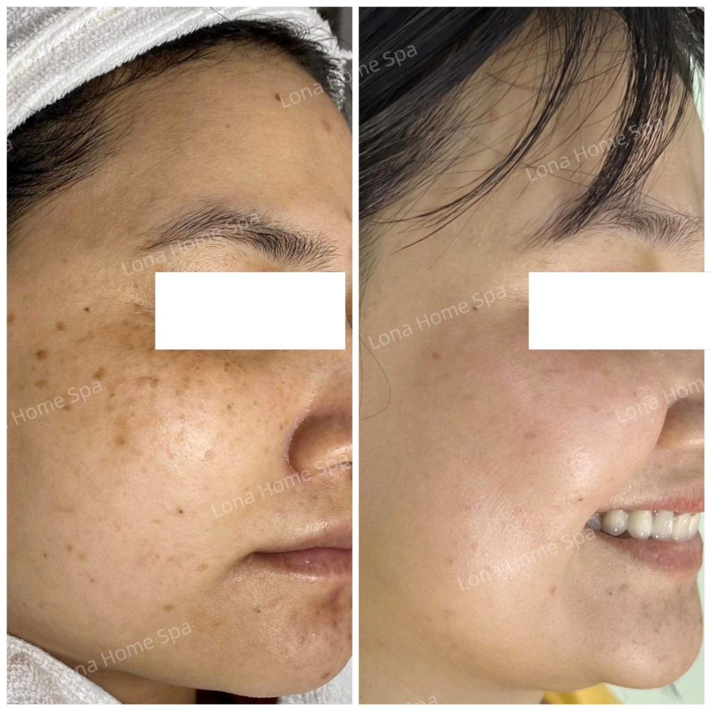 Hình ảnh minh họa không gian spa trị nám Cần Thơ hiện đại tại Lona Skin Lab, nơi cung cấp dịch vụ điều trị nám da Cần Thơ an toàn và hiệu quả.