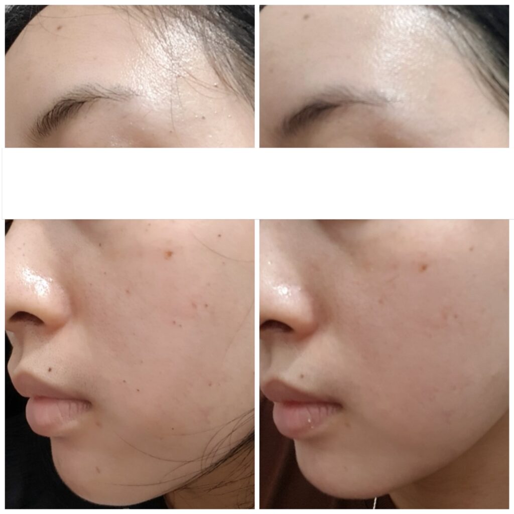 Hình ảnh trước và sau liệu trình trị tàn nhang tại Cần Thơ, thể hiện rõ hiệu quả của phương pháp trị tàn nhang hiện đại theo chỉ dẫn của các chuyên gia, được thực hiện tại spa uy tín Cần Thơ với quy trình chăm sóc da toàn diện.