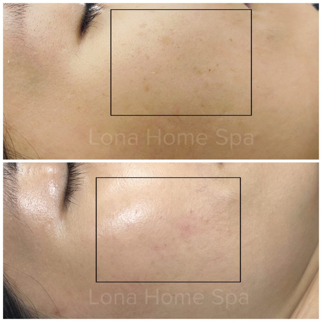 Hình ảnh thể hiện việc trị tàn nhang tại Cần Thơ với sự chỉ đạo của chuyên gia, kết hợp phương pháp tiên tiến tại spa uy tín Cần Thơ nhằm chăm sóc da tàn nhang và khôi phục vẻ đẹp tự nhiên.