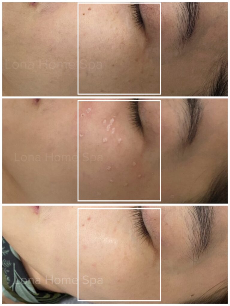 Hình ảnh minh họa quy trình trị tàn nhang tại Cần Thơ dưới sự giám sát của chuyên gia, kết hợp phong cách trị liệu tiên tiến của các spa uy tín tại Cần Thơ, đem lại làn da sáng mịn và đều màu.