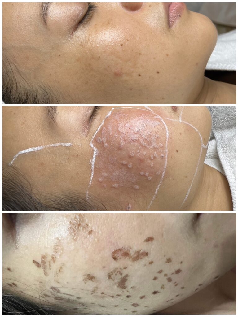 Những hình ảnh ấn tượng sau cùng minh chứng cho việc điều trị nám da Cần Thơ do bác sĩ da liễu trị nám Cần Thơ thực hiện tại phòng khám da liễu Cần Thơ, khẳng định vai trò của bác sĩ da liễu giỏi Cần Thơ và bác sĩ da liễu trị nám giỏi ở Cần Thơ trong việc đạt được trị nám hiệu quả Cần Thơ.