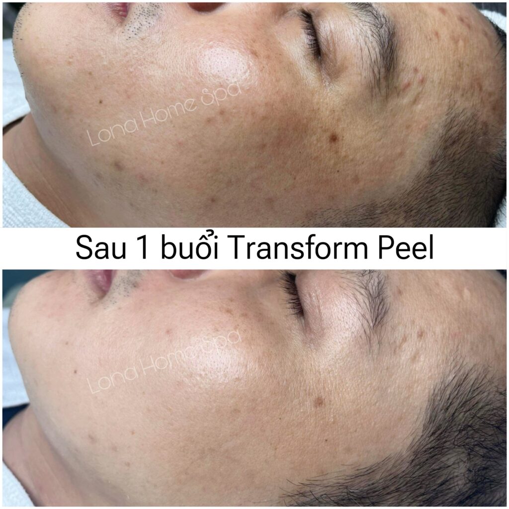 Kết quả điều trị từ bác sĩ da liễu trị nám Cần Thơ cho thấy quá trình điều trị nám da Cần Thơ tại phòng khám da liễu Cần Thơ luôn được dẫn dắt bởi bác sĩ da liễu giỏi Cần Thơ và bác sĩ da liễu trị nám giỏi ở Cần Thơ, tạo nên hiệu quả trị nám hiệu quả Cần Thơ vượt trội.