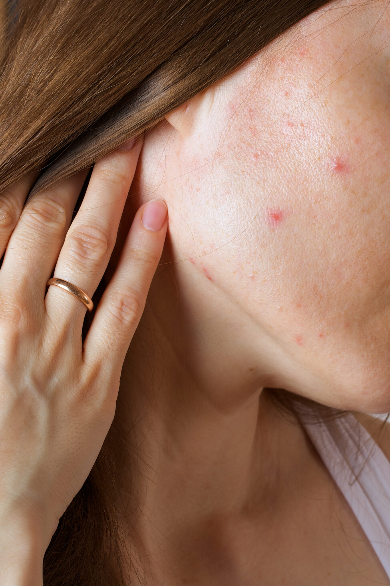 Hình ảnh danhaycam6 là minh chứng cho spa cho da nhạy cảm Cần Thơ, nơi điều trị da nhạy cảm tại Cần Thơ và điều trị da nhạy cảm Cần Thơ được triển khai dưới sự giám sát của chuyên gia da liễu.