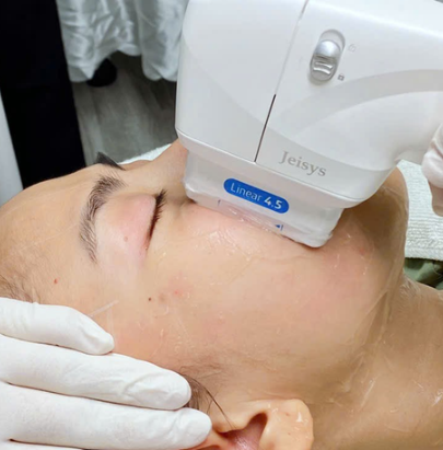 Bức ảnh thể hiện quá trình HIFU nâng cơ tại Cần Thơ qua Hifu nâng cơ Cần Thơ, với sự dẫn dắt của các bác sĩ giỏi nâng cơ tại Lona Skin Lab mang lại hiệu quả trẻ hóa da Cần Thơ vượt trội nhờ công nghệ Hifu tiên tiến.