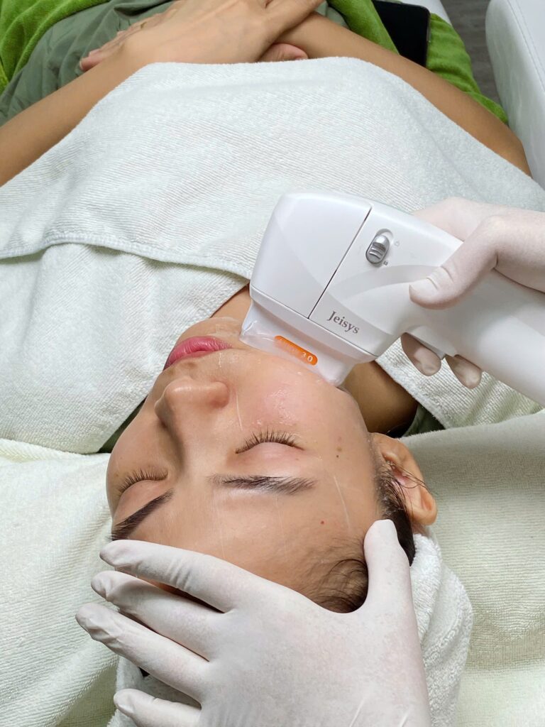 Bức ảnh minh họa quá trình nâng cơ mặt không xâm lấn tại Cần Thơ sử dụng công nghệ HIFU Cần Thơ, với bác sĩ giỏi Lona Skin Lab điều phối, đảm bảo nâng cơ mặt không xâm lấn và trẻ hóa da không phẫu thuật.