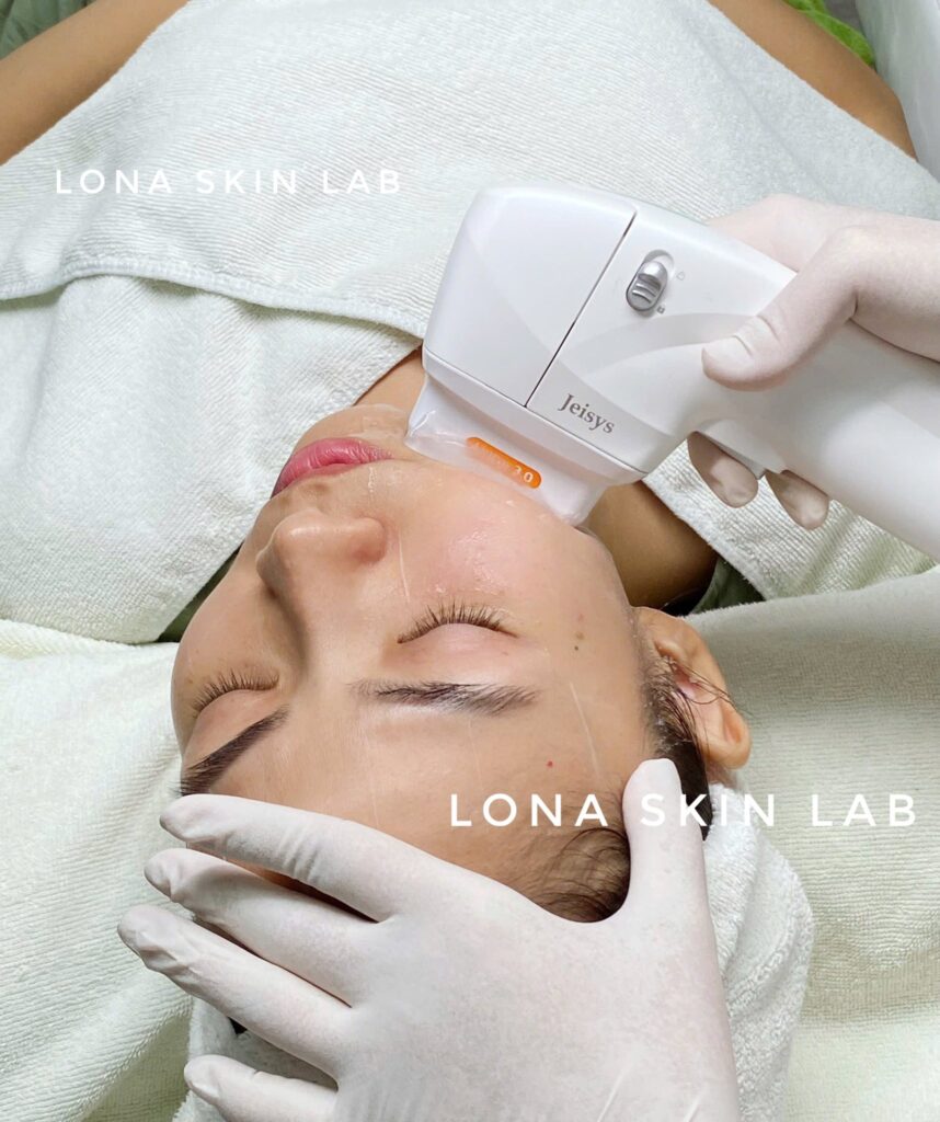 Với cam kết của Lona Skin Lab, các bác sĩ giỏi Cần Thơ sử dụng Ultherapy tại Cần Thơ và Ultherapy Cần Thơ để tiến hành nâng cơ không phẫu thuật, qua đó giúp trẻ hóa da Cần Thơ một cách hiệu quả và lâu dài.