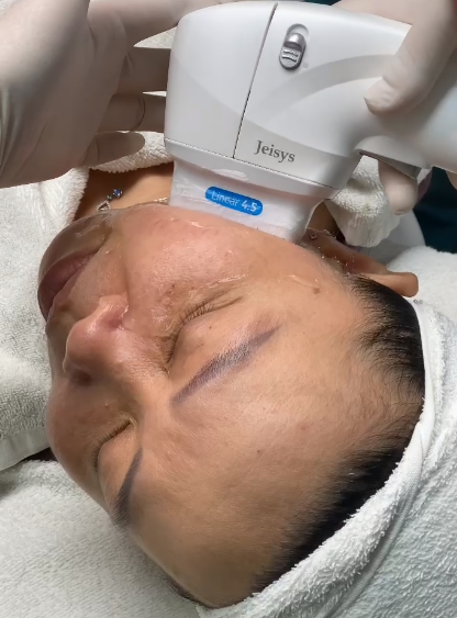 Với sự ứng dụng của Ultherapy tại Cần Thơ và Ultherapy Cần Thơ, Lona Skin Lab tận dụng tay nghề của bác sĩ giỏi Cần Thơ để thực hiện nâng cơ không phẫu thuật và trẻ hóa da Cần Thơ một cách tối ưu.
