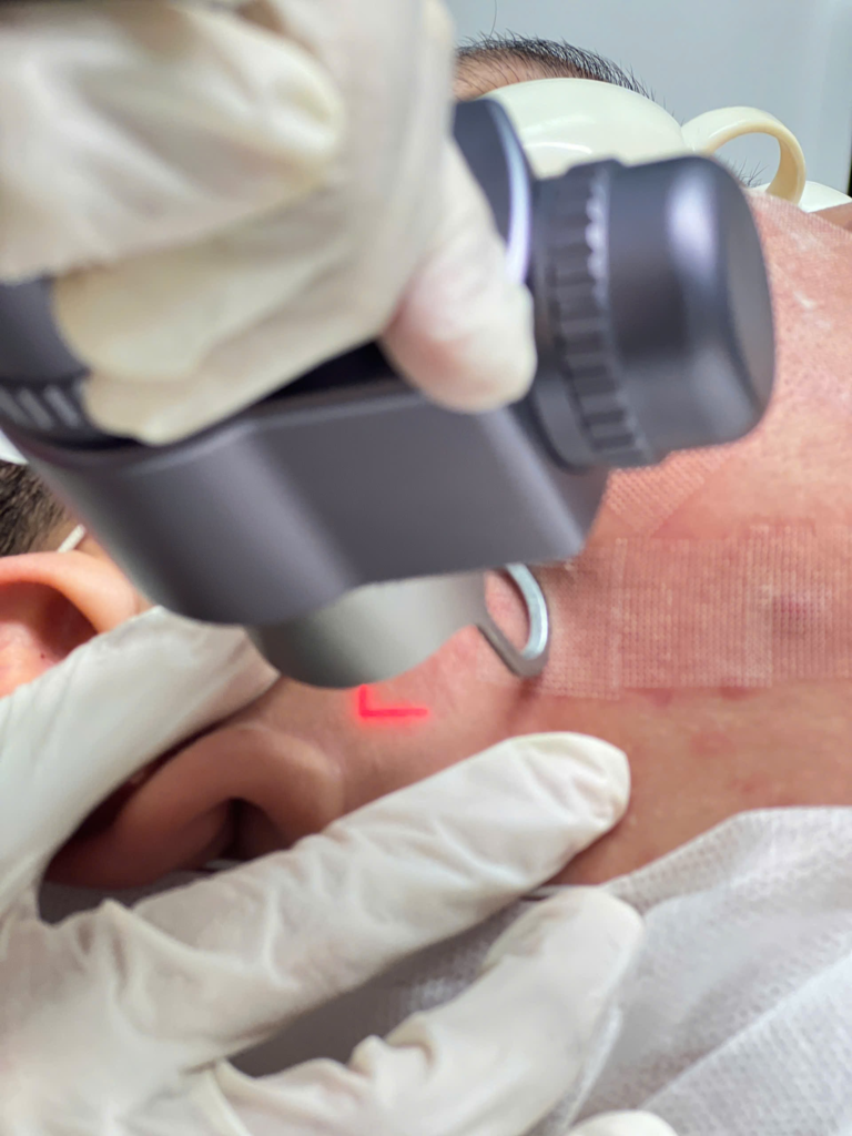Tại Lona Skin Lab, kỹ thuật bắn laser trị nám bong vảy được thực hiện với tiêu chuẩn cao, đảm bảo tính an toàn và hiệu quả.