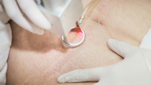Hình ảnh laser co2 fractional trị rạn da tại Cần Thơ được các chuyên gia khuyên dùng nhằm điều trị rạn da an toàn và hiệu quả.