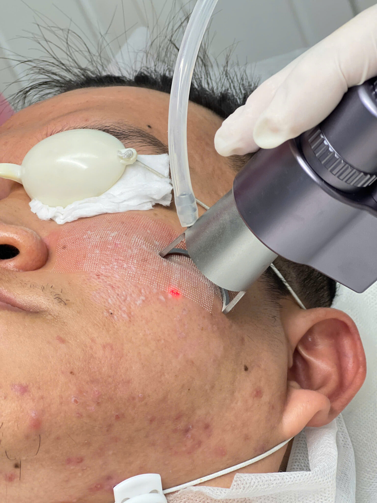 Hình ảnh thể hiện quy trình laser cao cấp tại Lona Skin Lab, một phòng khám da liễu Cần Thơ chuyên về trị sẹo uy tín tại Cần Thơ và điều trị sẹo rỗ Cần Thơ, góp phần khẳng định vị thế spa trị sẹo Cần Thơ hàng đầu.