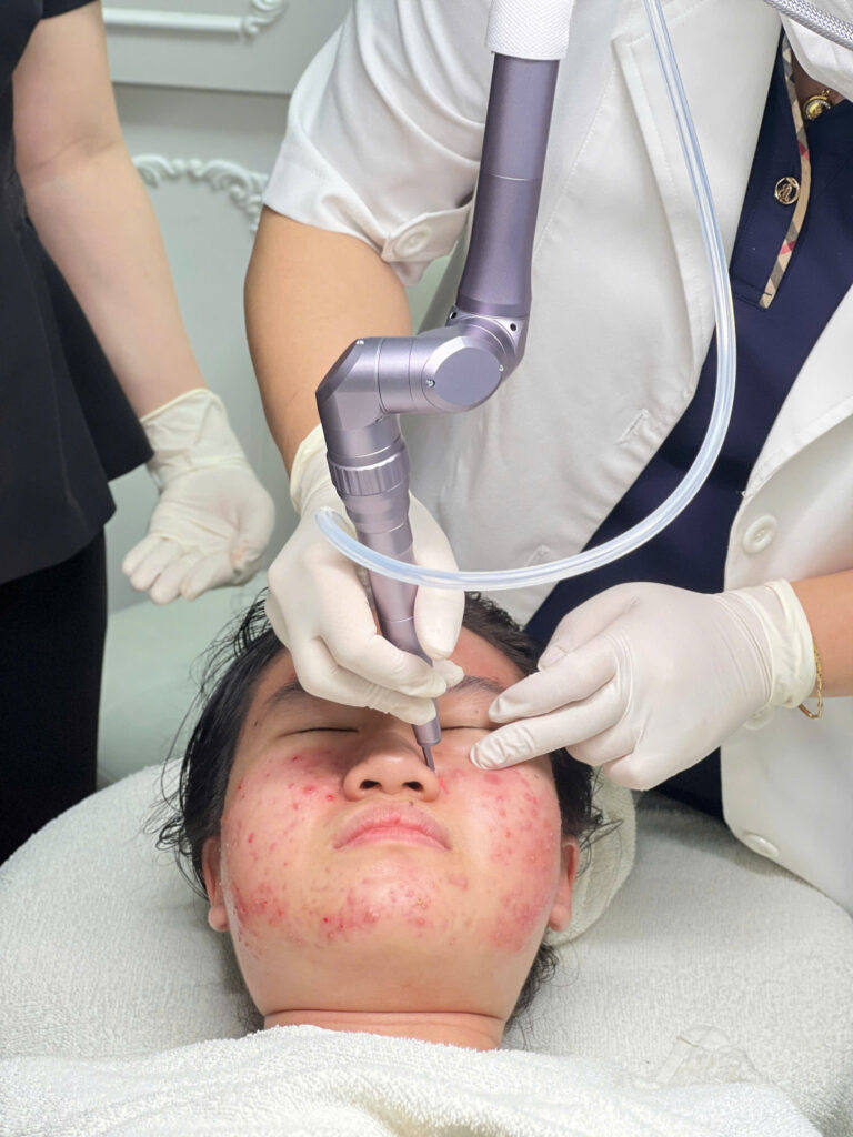 Với công nghệ bắn laser trị nám bong vảy, quá trình theo dõi giúp chăm sóc da sau laser đạt hiệu quả cao.