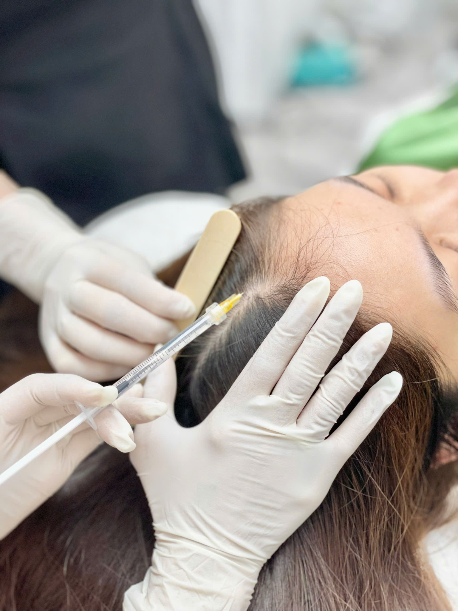 Hình ảnh trình bày phương pháp mesotherapy tóc trong quá trình tiêm meso tóc tại Cần Thơ, được chuyên gia Lona trực tiếp thực hiện nhằm điều trị rụng tóc Cần Thơ và kích thích mọc tóc Cần Thơ, cũng như tiêm meso tóc Cần Thơ với kết quả tối ưu.