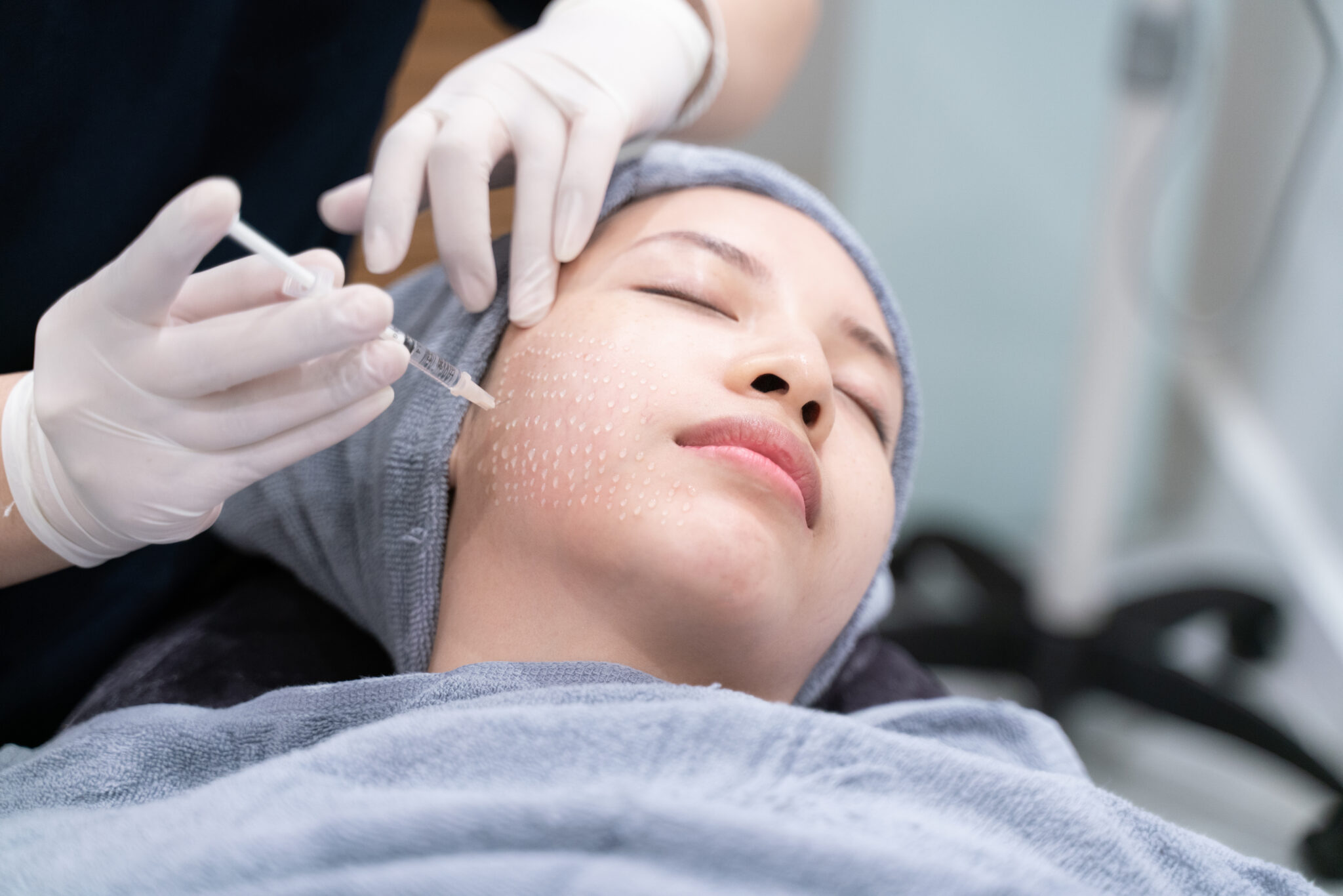 Ảnh thể hiện quy trình tiêm sáng da bằng meso tại Cần Thơ, qua đó khách hàng được trải nghiệm tiêm sáng da bằng meso và tiêm meso làm trắng da an toàn cùng đội ngũ bác sĩ giỏi Lona Skin Lab.
