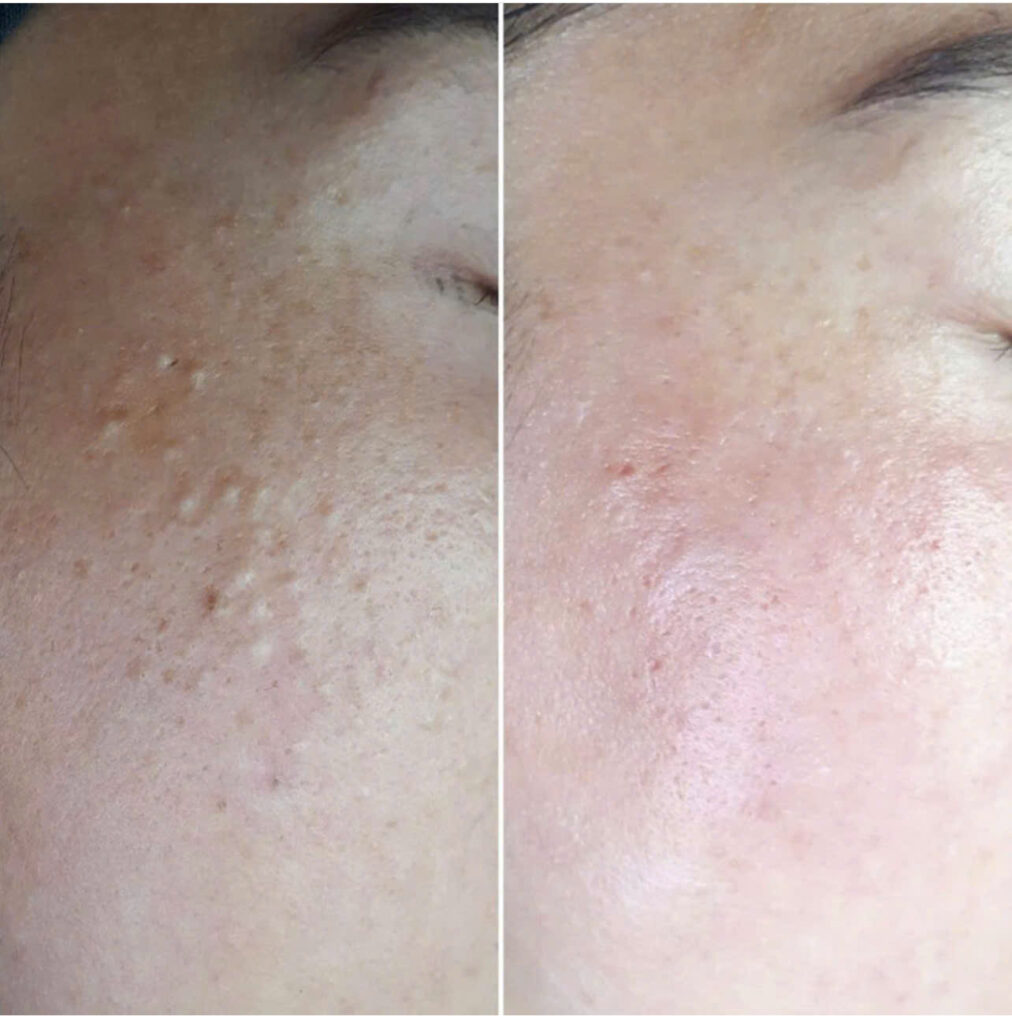 Tại Lona Skin Lab, chuyên gia Lona của Lona Home Spa đã khéo léo thực hiện trị mụn đầu đen tại Cần Thơ, qua đó xác lập tiêu chuẩn chuyên môn tại spa trị mụn Cần Thơ.