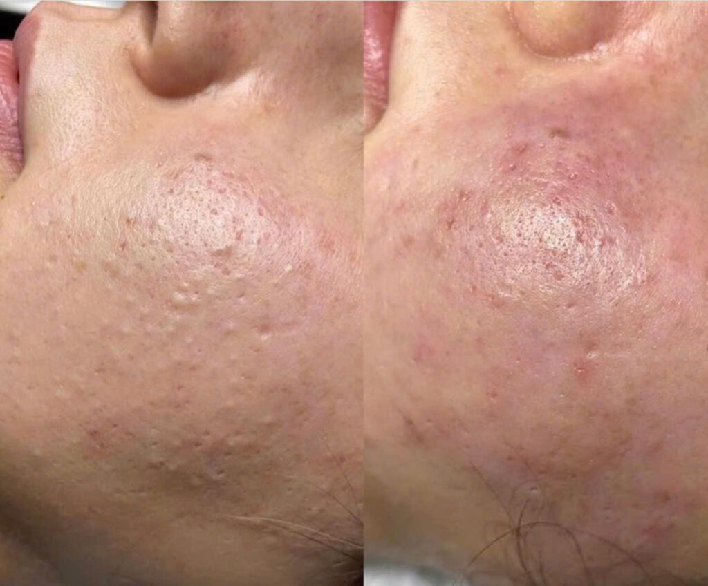 Với chuyên gia Lona hàng đầu, quy trình trị mụn đầu đen tại Cần Thơ tại Lona Home Spa và Lona Skin Lab được tiến hành theo phương pháp chuyên sâu của spa trị mụn Cần Thơ.