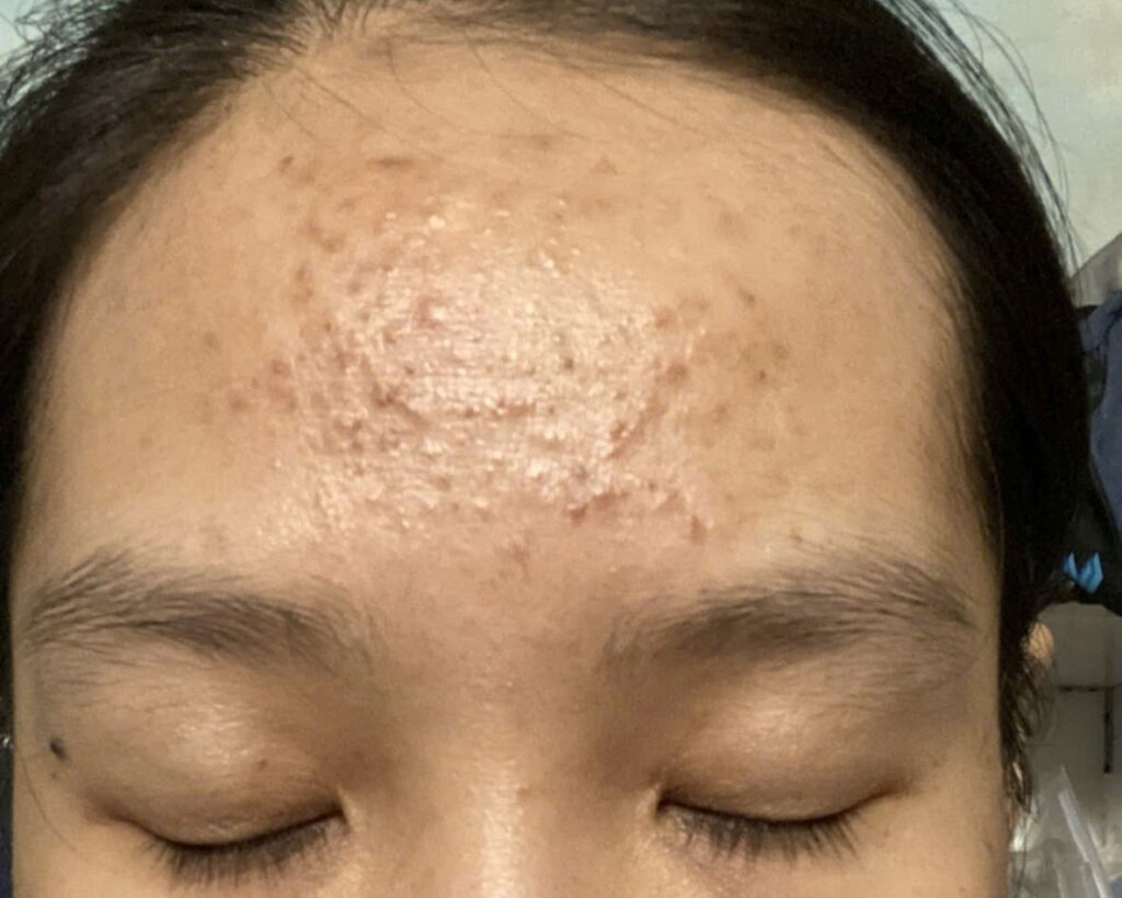 Chuyên gia Lona tại Lona Skin Lab và Lona Home Spa triển khai quy trình trị mụn đầu đen tại Cần Thơ một cách chính xác, khẳng định vai trò tiên phong của spa trị mụn Cần Thơ.