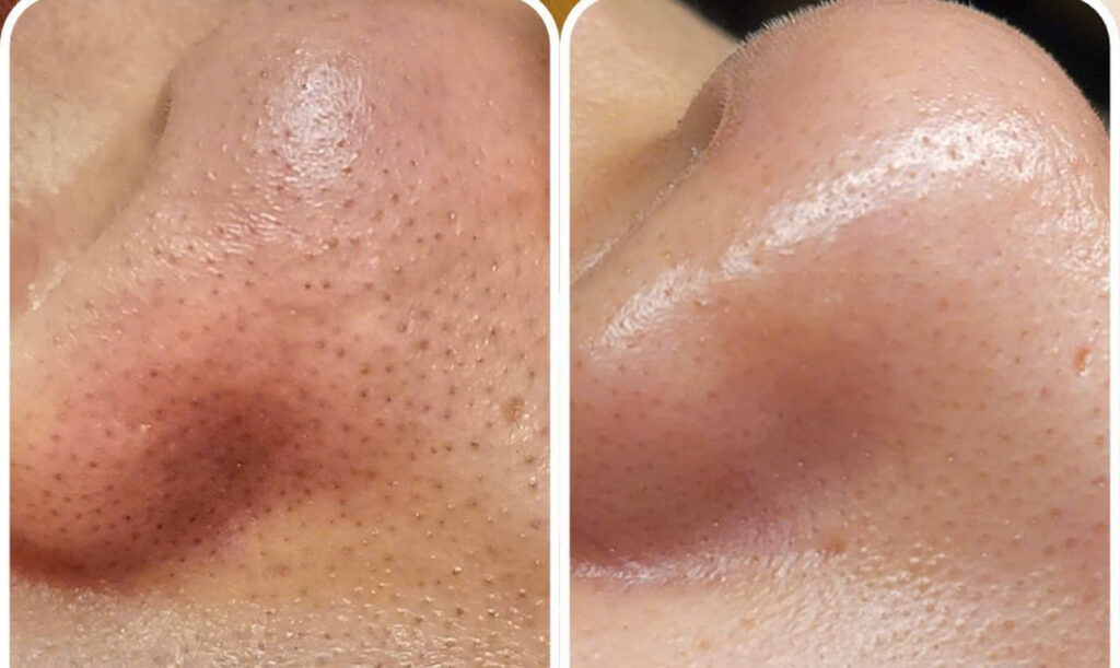 Với chuyên gia Lona, Lona Skin Lab và Lona Home Spa đã triển khai quy trình trị mụn đầu đen tại Cần Thơ một cách chuyên sâu, qua đó khẳng định vị thế của spa trị mụn Cần Thơ trong việc chăm sóc da.