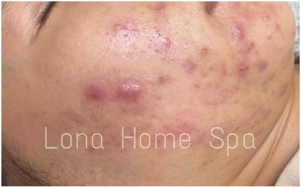 Kết hợp kinh nghiệm của chuyên gia Lona, Lona Home Spa và Lona Skin Lab, phương pháp trị mụn đầu đen tại Cần Thơ được thực hiện chuyên nghiệp, củng cố uy tín của spa trị mụn Cần Thơ.