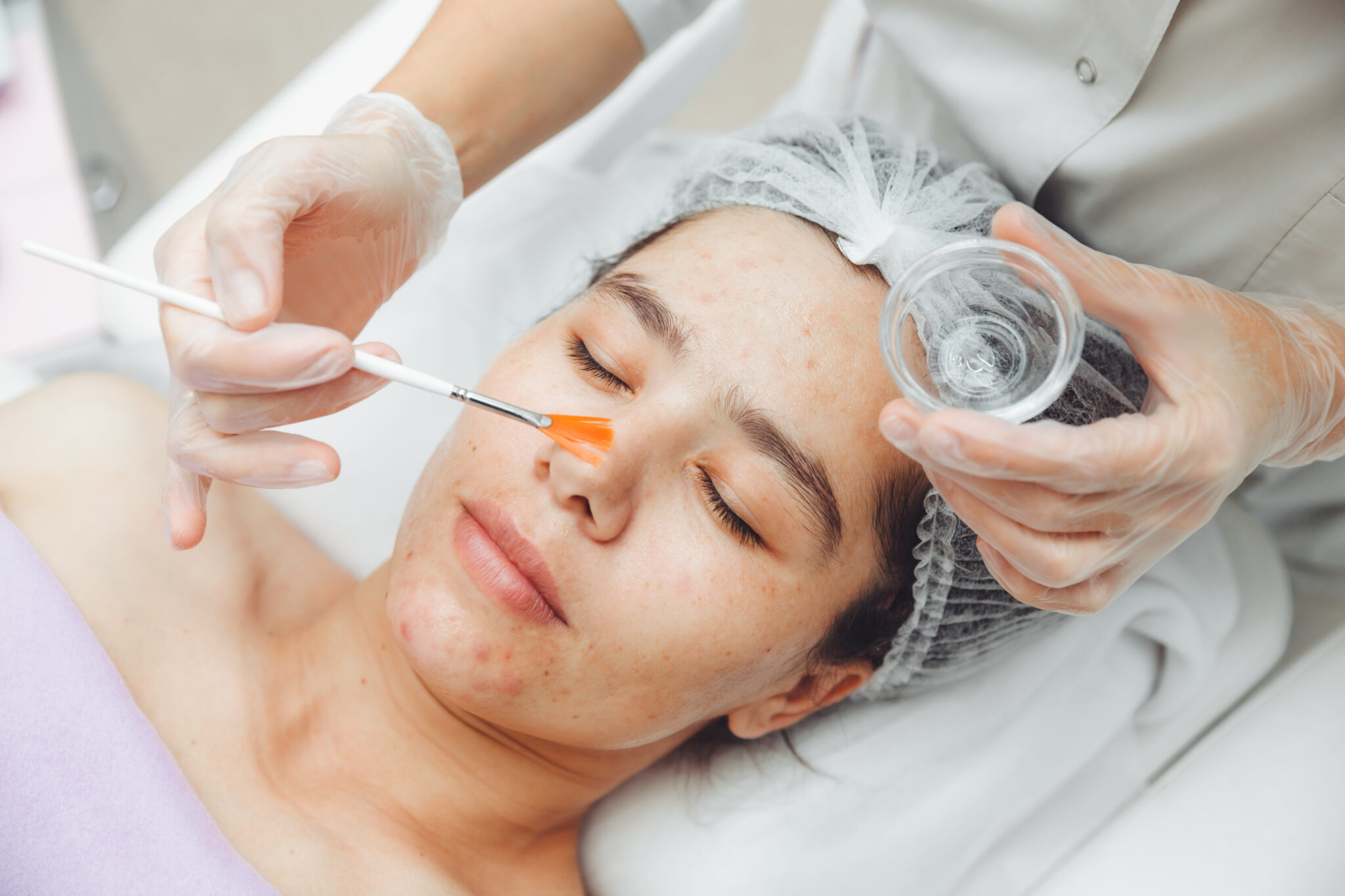 Hình ảnh cho thấy hiệu quả của liệu trình peel da tại Cần Thơ, nơi chuyên gia Lona áp dụng peel da an toàn đồng thời cung cấp dịch vụ peel da Cần Thơ đạt chuẩn trong chăm sóc da.