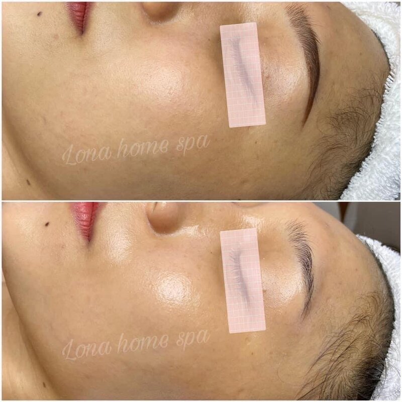 Bức hình thể hiện các bước chăm sóc da tiên tiến, hỗ trợ việc Điều trị nám hiệu quả dưới sự giám sát của Chuyên gia Lona và Peel da an toàn.