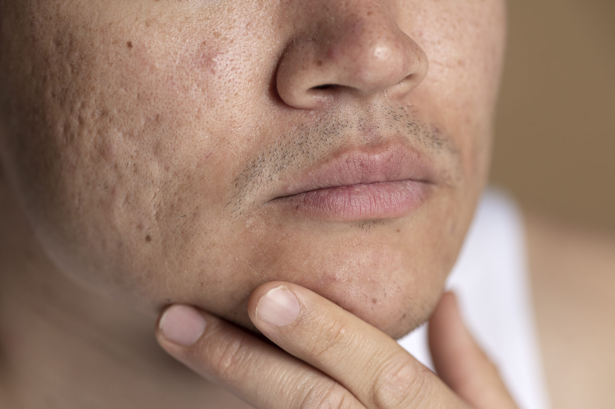 Sử dụng công nghệ trị sẹo rỗ tiên tiến tại Cần Thơ, Lona Skin Lab đem lại trải nghiệm điều trị sẹo rỗ tại Cần Thơ hiệu quả cho khách hàng.