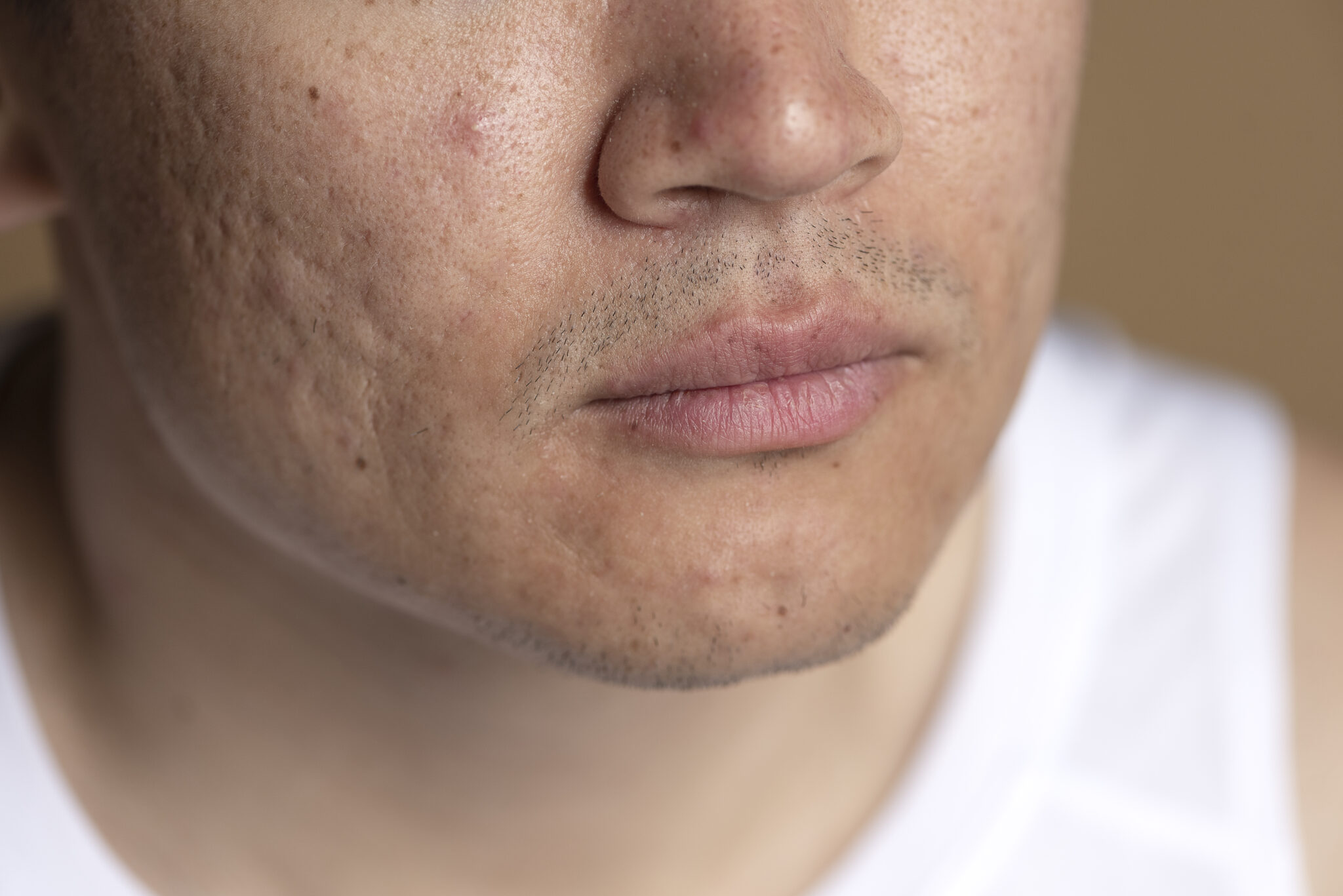 Trải qua liệu trình điều trị sẹo rỗ tại Cần Thơ tại Lona Skin Lab, khách hàng đã đạt được hiệu quả trị sẹo rỗ hiệu quả nhờ công nghệ trị sẹo rỗ tiên tiến.
