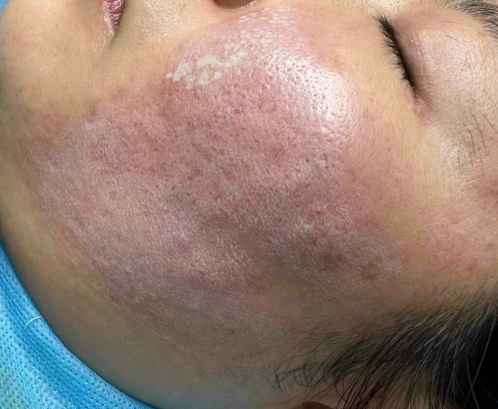 Các chuyên gia khẳng định hiệu quả điều trị mụn tại Cần Thơ nhờ sự kết hợp giữa spa trị mụn và phòng khám da liễu hiện đại.